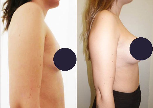 breast augmentation before & after photos