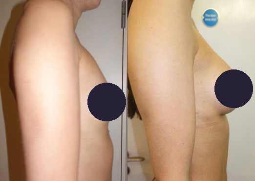 Tummy Tuck before & after photos