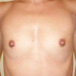 Breast Augmentation Before & After Patient #466