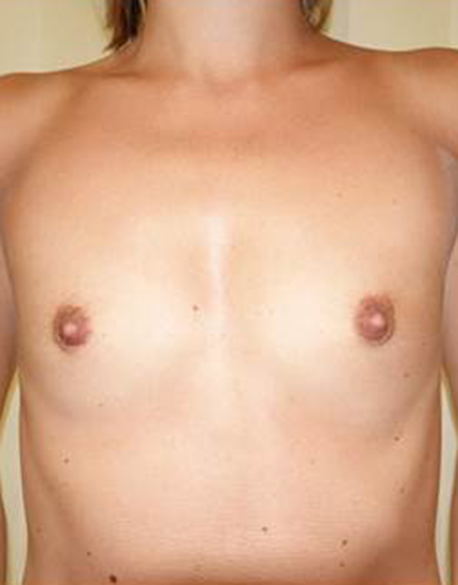 Breast Augmentation Before & After Patient #466