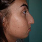 Rhinoplasty Before & After Patient #520