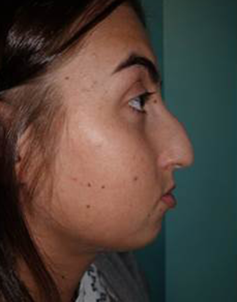 Rhinoplasty Before & After Patient #520