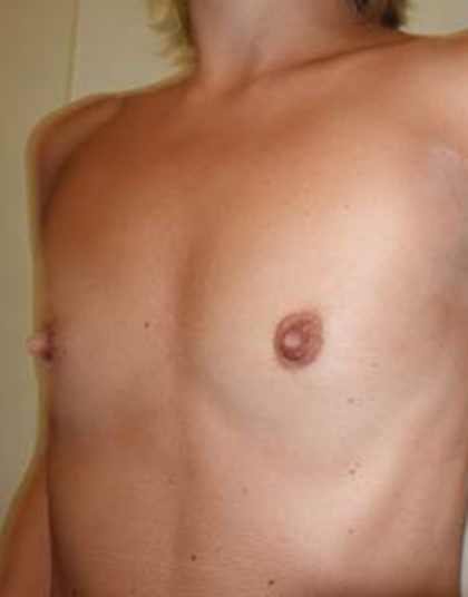 Breast Augmentation Before & After Patient #466