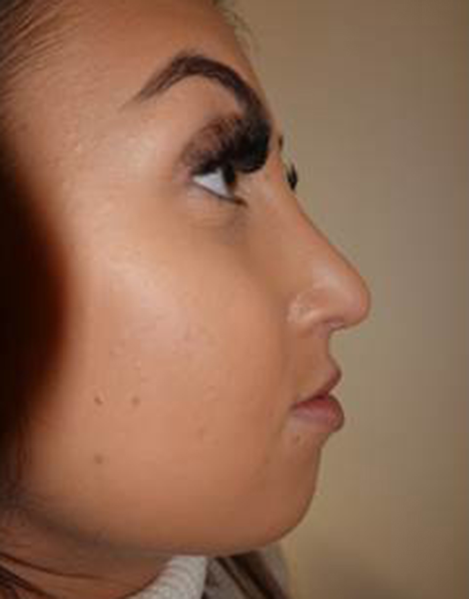 Rhinoplasty Before & After Patient #520