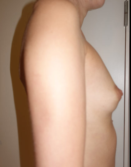 Breast Augmentation Before & After Patient #258
