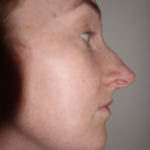 Rhinoplasty Before & After Patient #415