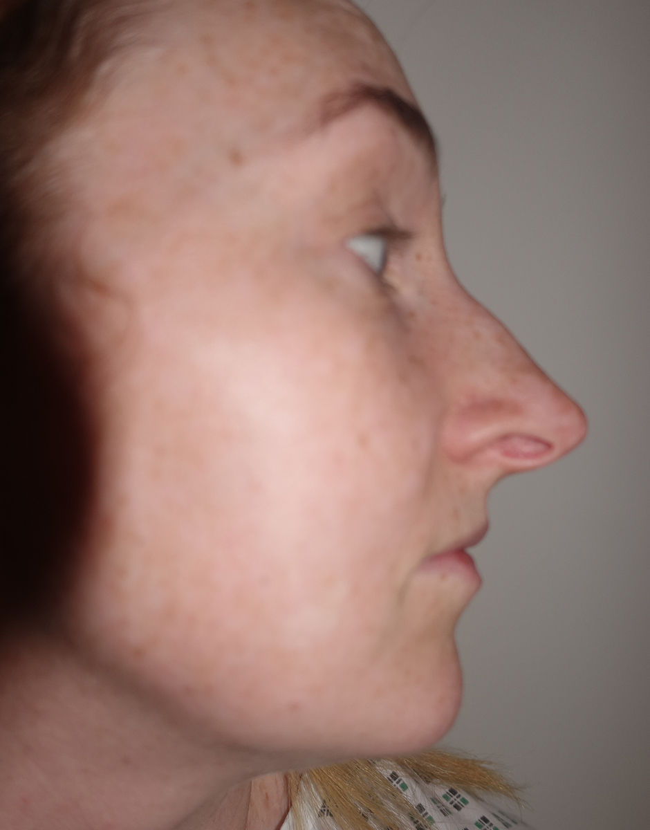Rhinoplasty Before & After Patient #415