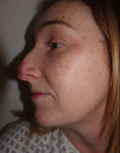 Rhinoplasty Before & After Patient #415