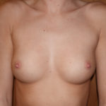 Breast Augmentation Before & After Patient #464