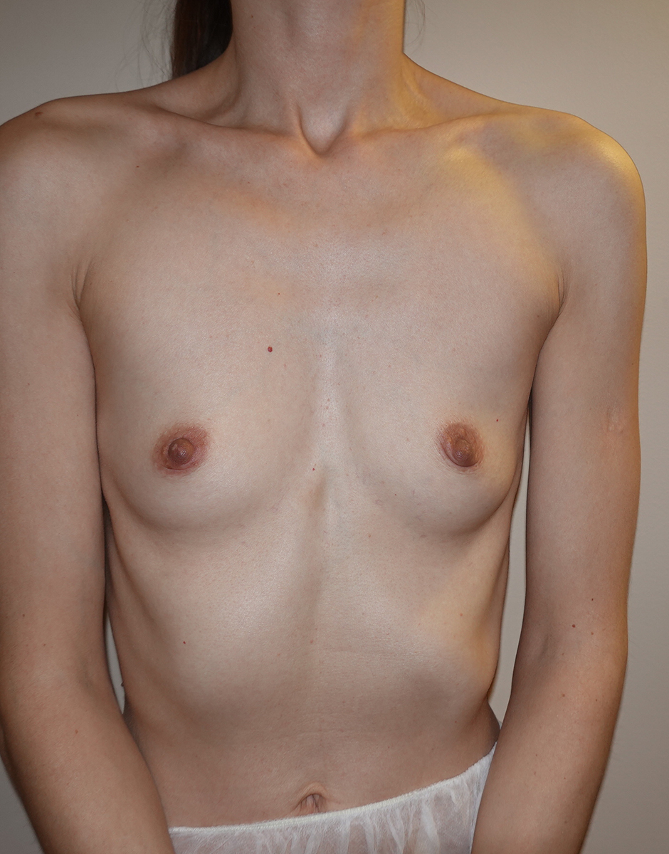 Breast Augmentation Before & After Patient #283