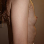 Breast Augmentation Before & After Patient #283