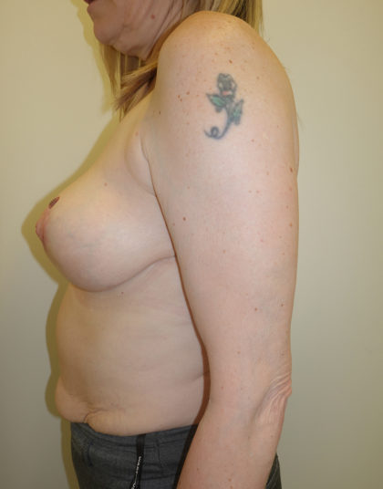 Breast Lift Before & After Patient #282