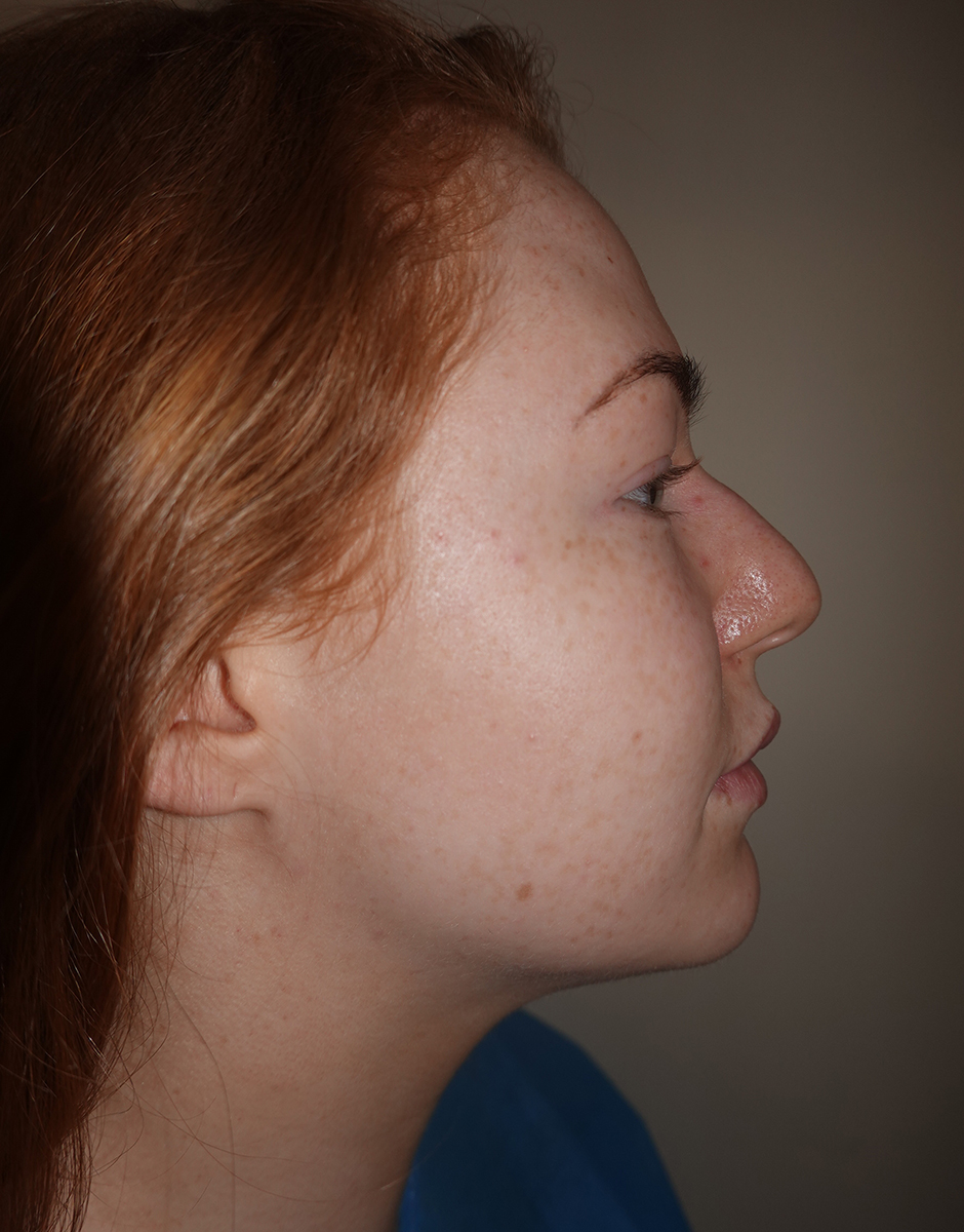 Rhinoplasty Before & After Patient #380