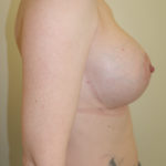 Breast Augmentation Before & After Patient #507