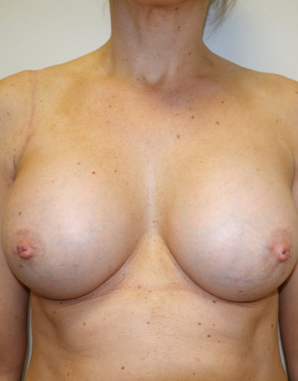 Breast Augmentation Before & After Patient #308