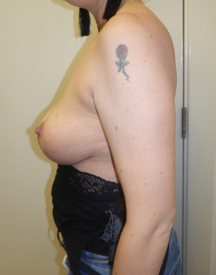 Breast Lift Before & After Patient #344