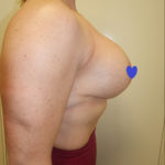 Breast Augmentation Before & After Patient #234
