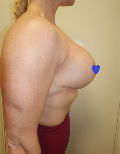 Breast Augmentation Before & After Patient #234