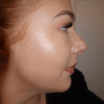 Rhinoplasty Before & After Patient #380
