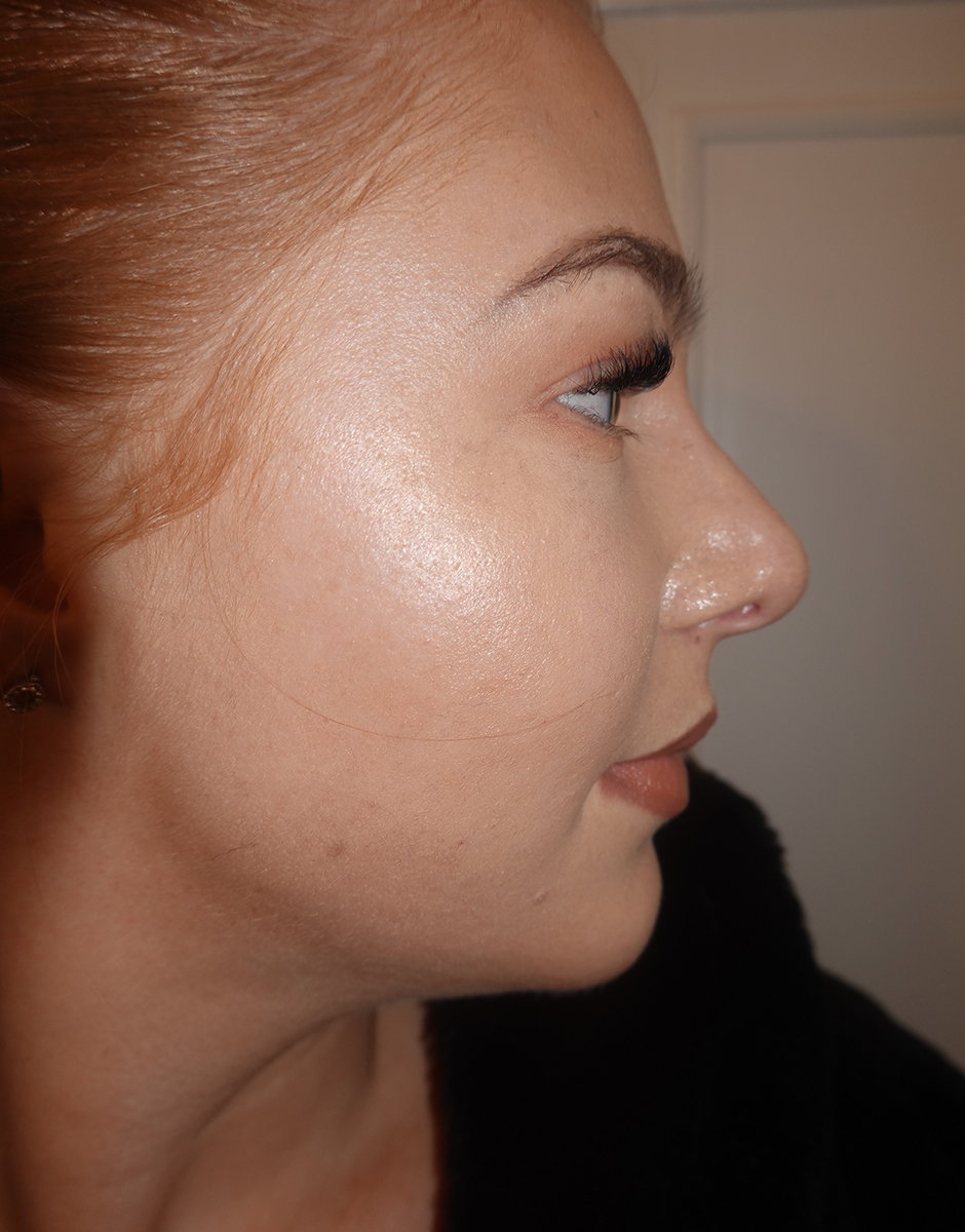 Rhinoplasty Before & After Patient #380