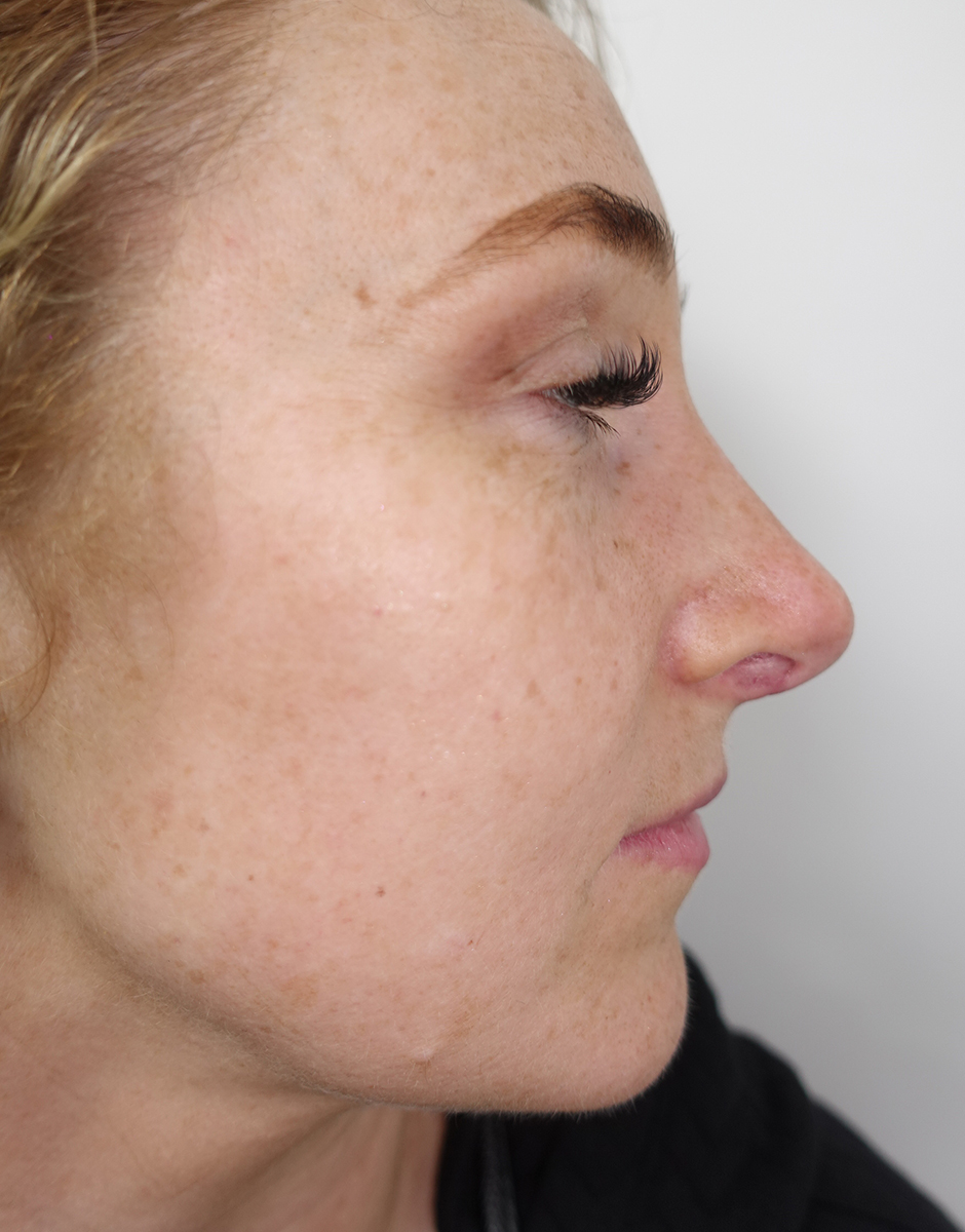 Rhinoplasty Before & After Patient #415