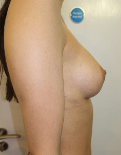 Breast Augmentation Before & After Patient #258