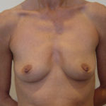 Breast Augmentation Before & After Patient #218