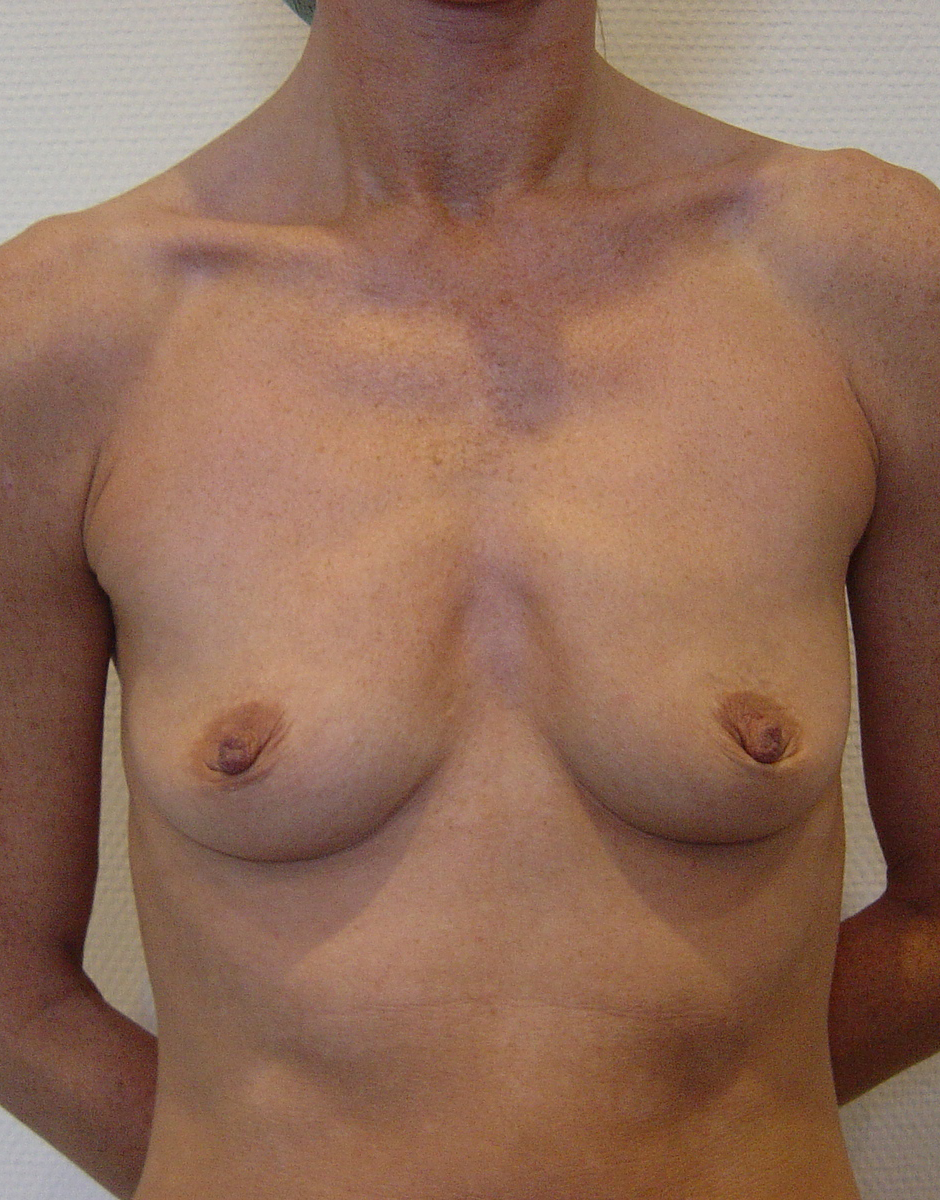 Breast Augmentation Before & After Patient #218