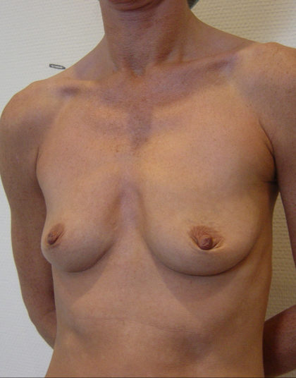 Breast Augmentation Before & After Patient #218