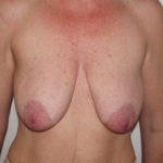 Breast Augmentation Before & After Patient #432