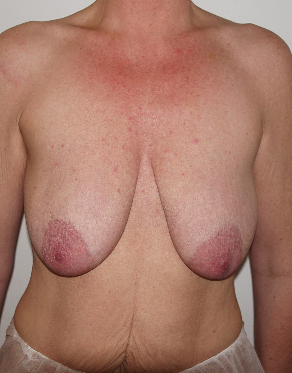 Breast Augmentation Before & After Patient #432