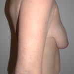 Breast Augmentation Before & After Patient #432