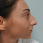 Rhinoplasty Before & After Patient #379
