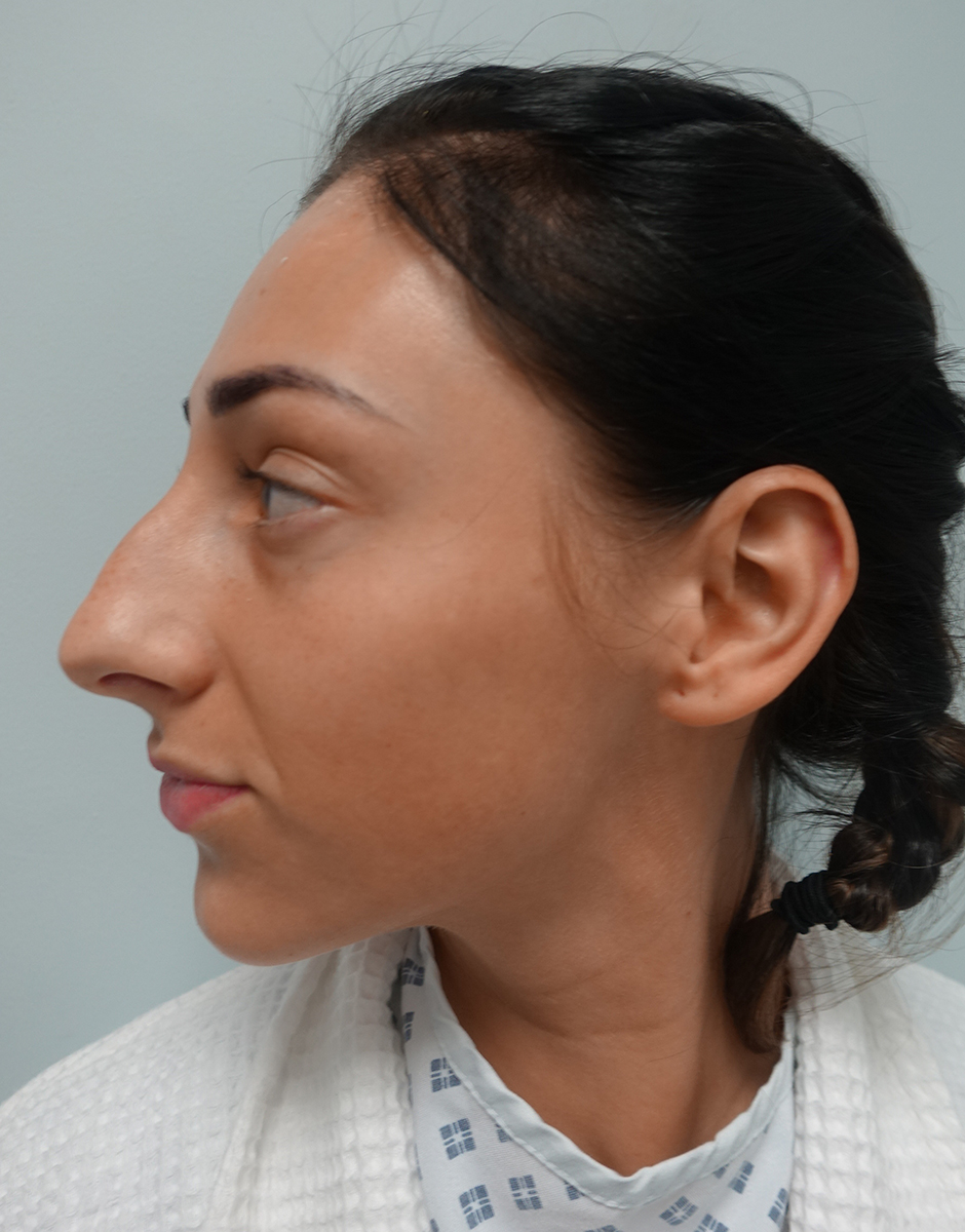 Rhinoplasty Before & After Patient #379