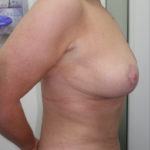 Breast Lift Before & After Patient #334