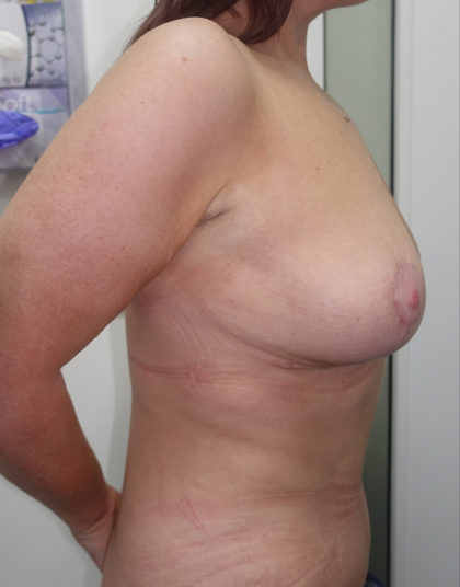Breast Lift Before & After Patient #334