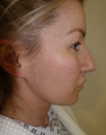 Rhinoplasty Before & After Patient #394