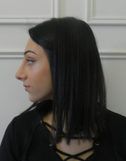 Rhinoplasty Before & After Patient #379