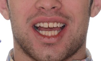 All-Porcelain and Composite Veneers Before & After Patient #565