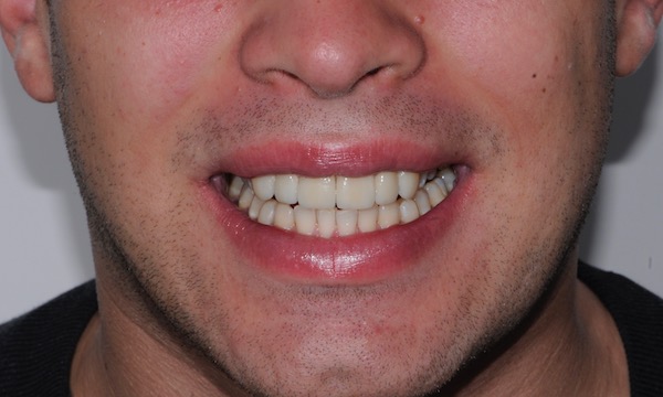 All-Porcelain and Composite Veneers Before & After Patient #565