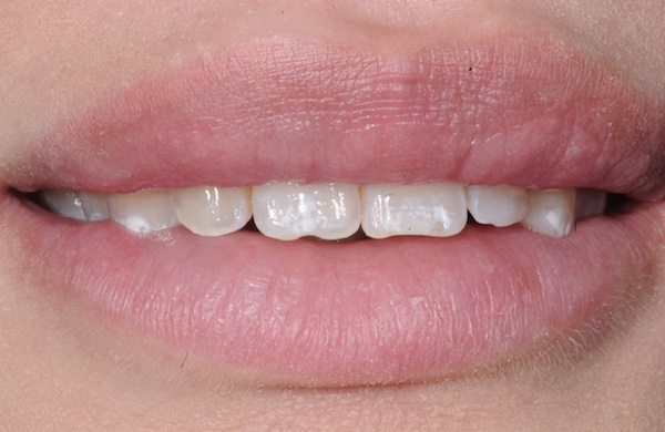 All-Porcelain and Composite Veneers Before & After Patient #568