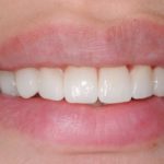 All-Porcelain and Composite Veneers Before & After Patient #568