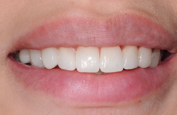 All-Porcelain and Composite Veneers Before & After Patient #568