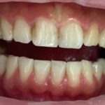 All-Porcelain and Composite Veneers Before & After Patient #571