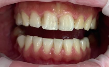 All-Porcelain and Composite Veneers Before & After Patient #571