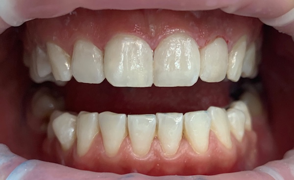 All-Porcelain and Composite Veneers Before & After Patient #571