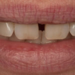 All-Porcelain and Composite Veneers Before & After Patient #579
