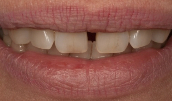 All-Porcelain and Composite Veneers Before & After Patient #579