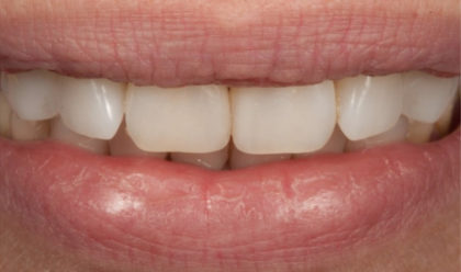 All-Porcelain and Composite Veneers Before & After Patient #579