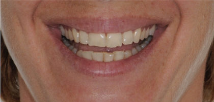 All-Porcelain and Composite Veneers Before & After Patient #577